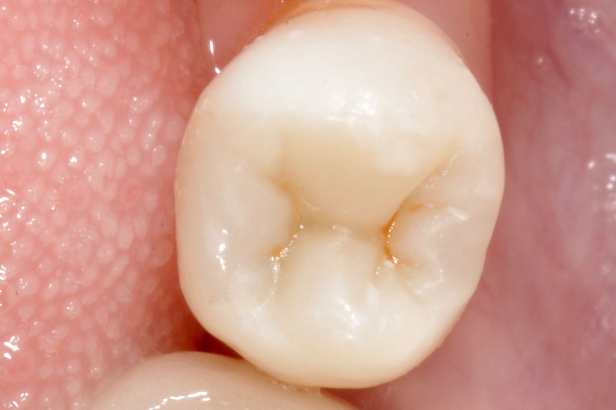 torsello-milani-piacenza-dentisti-carie-conservativa-dopo