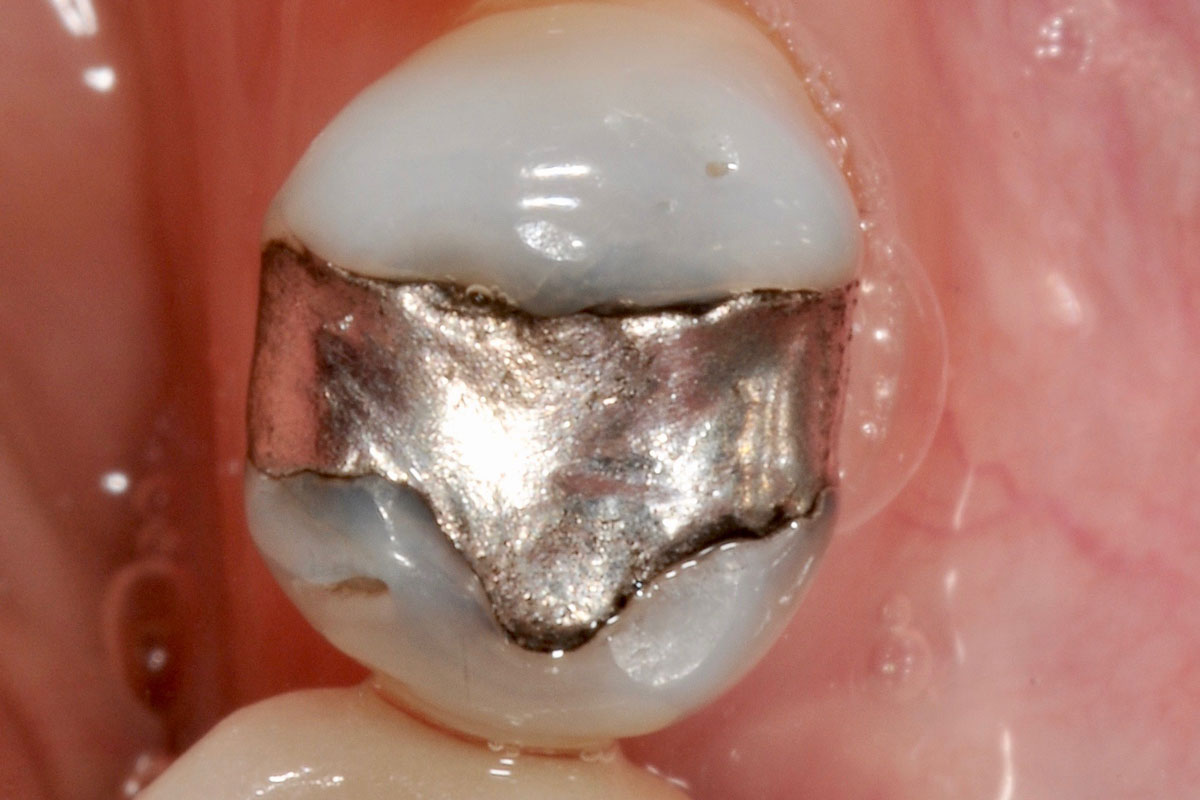 torsello-milani-piacenza-dentisti-carie-conservativa-prima