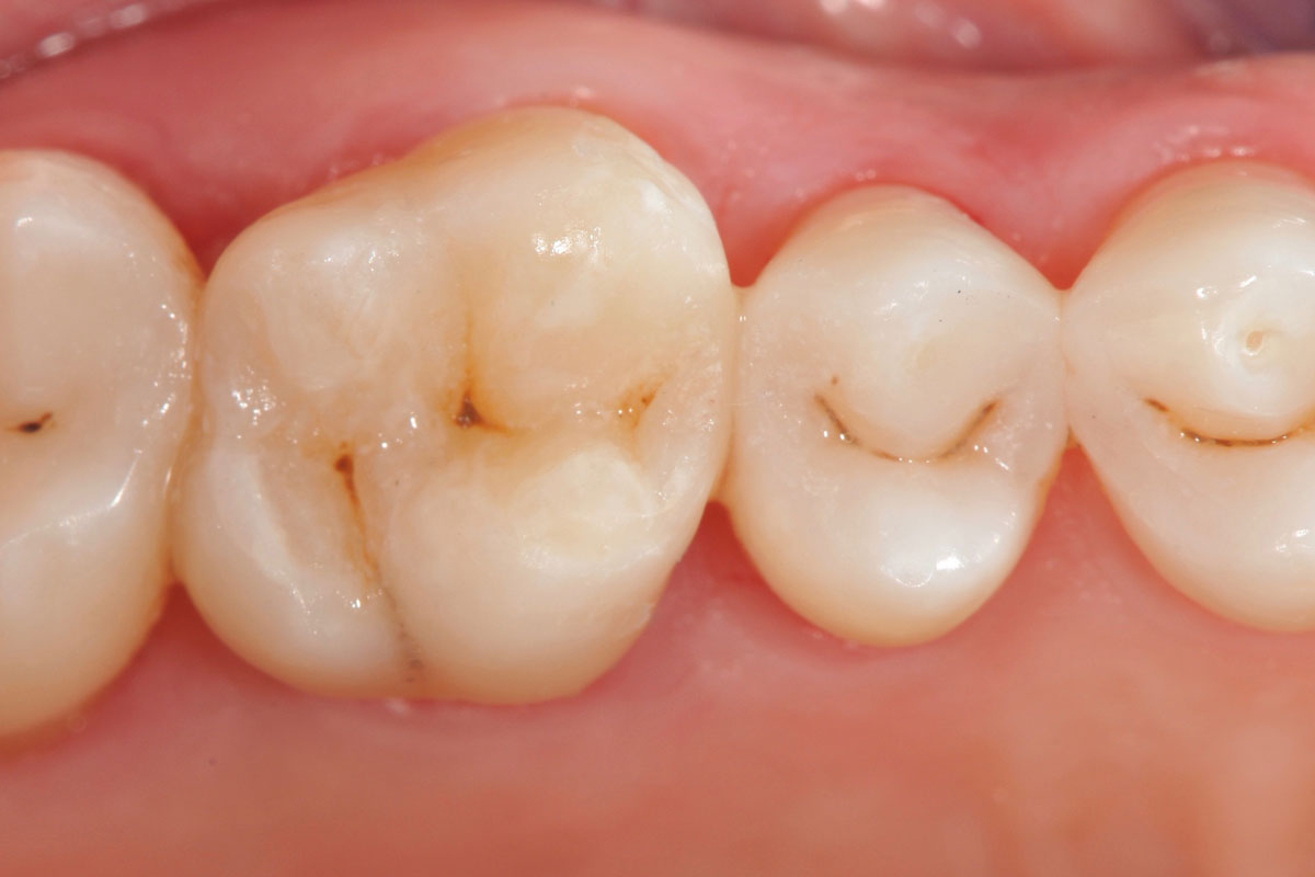 torsello-milani-piacenza-dentisti-endodonzia-dopo