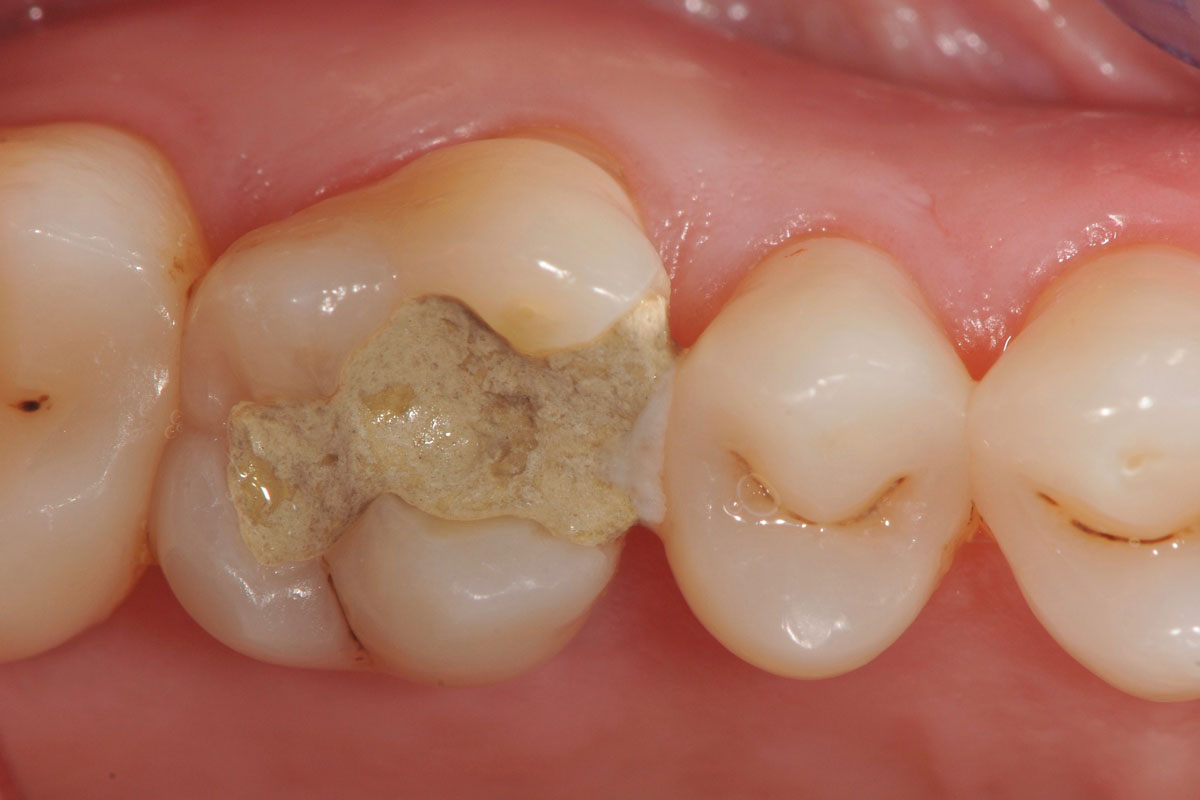 torsello-milani-piacenza-dentisti-endodonzia-prima