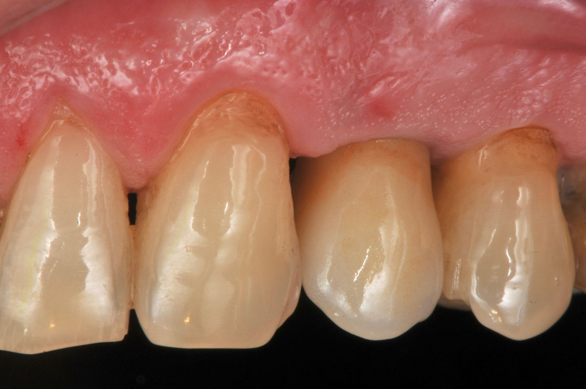 torsello-milani-piacenza-dentisti-impiantologia-dopo