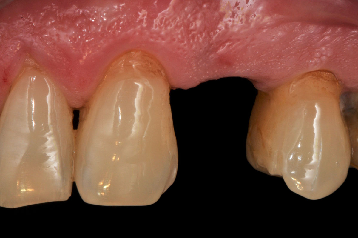 torsello-milani-piacenza-dentisti-impiantologia-prima