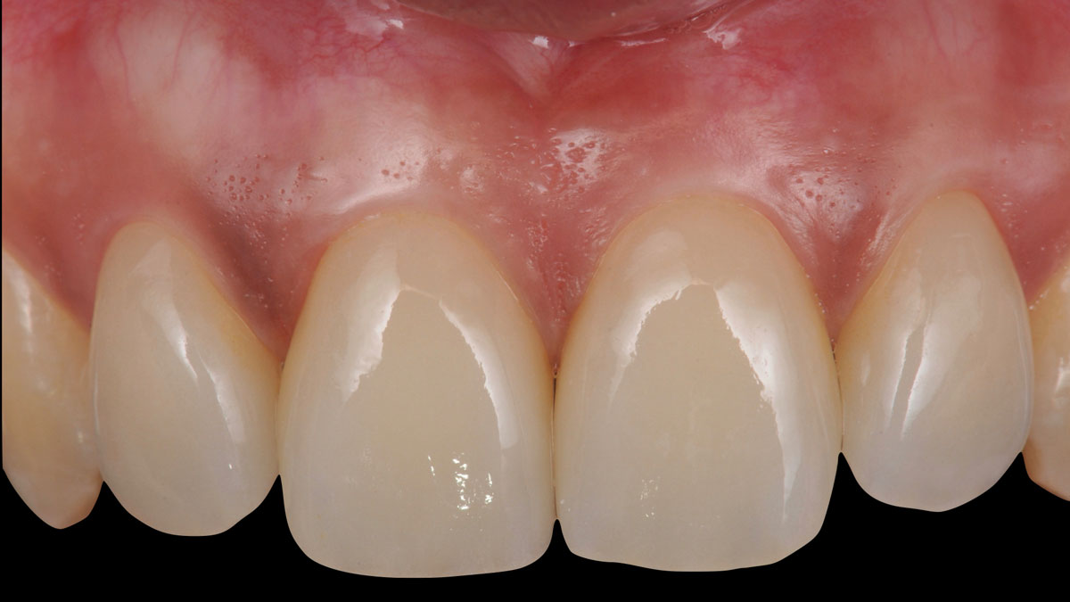 torsello-milani-piacenza-dentisti-protesi-dopo