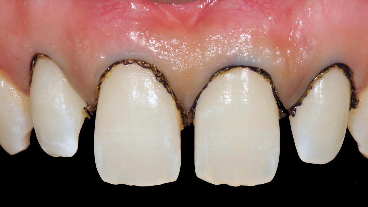 torsello-milani-piacenza-dentisti-protesi-prima